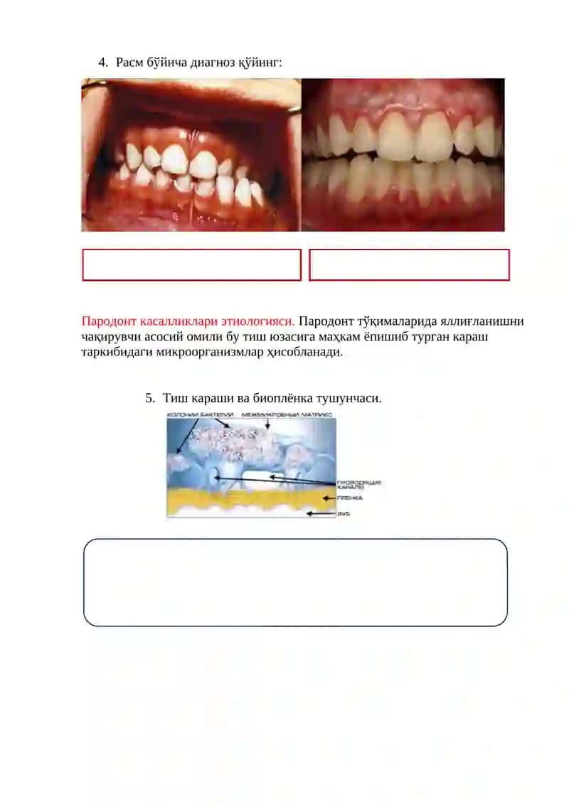 Bolalarda parodont kasalliklari tasnifi. Bolalar parodont kasalliklarining etiologiyasi va patogenezi 4
