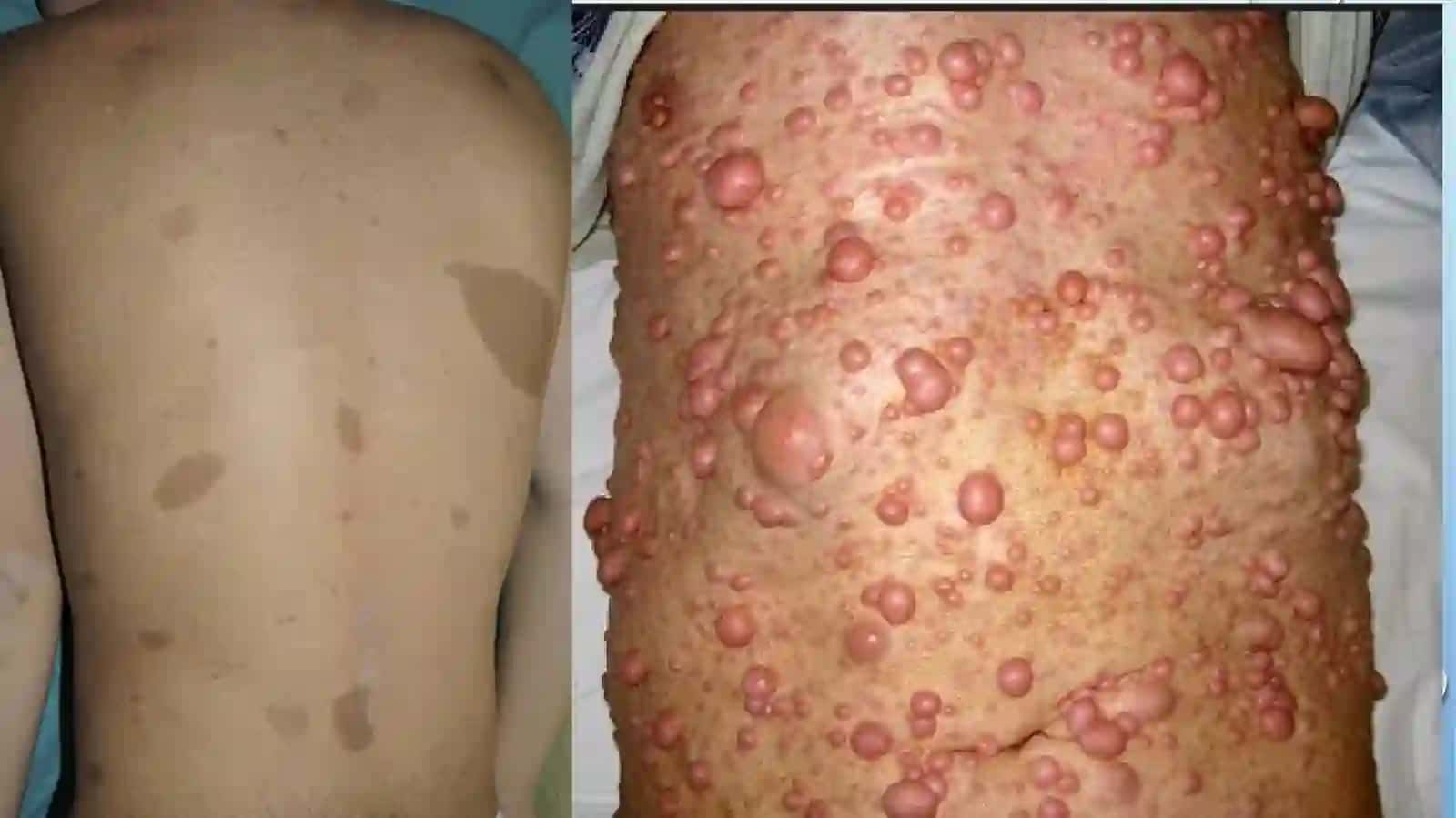 Neyrofibromatoz 4
