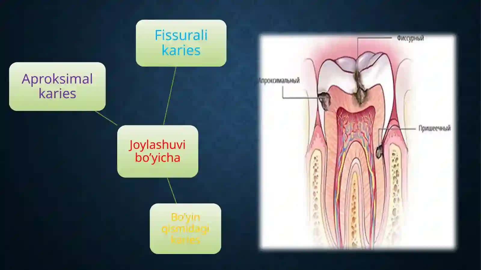 Tish qattiq to'qimalaridan nuqsonning joylashishi va chuqurligiga qarab kompozit plomba ashyosini tanlash mezonlari 4