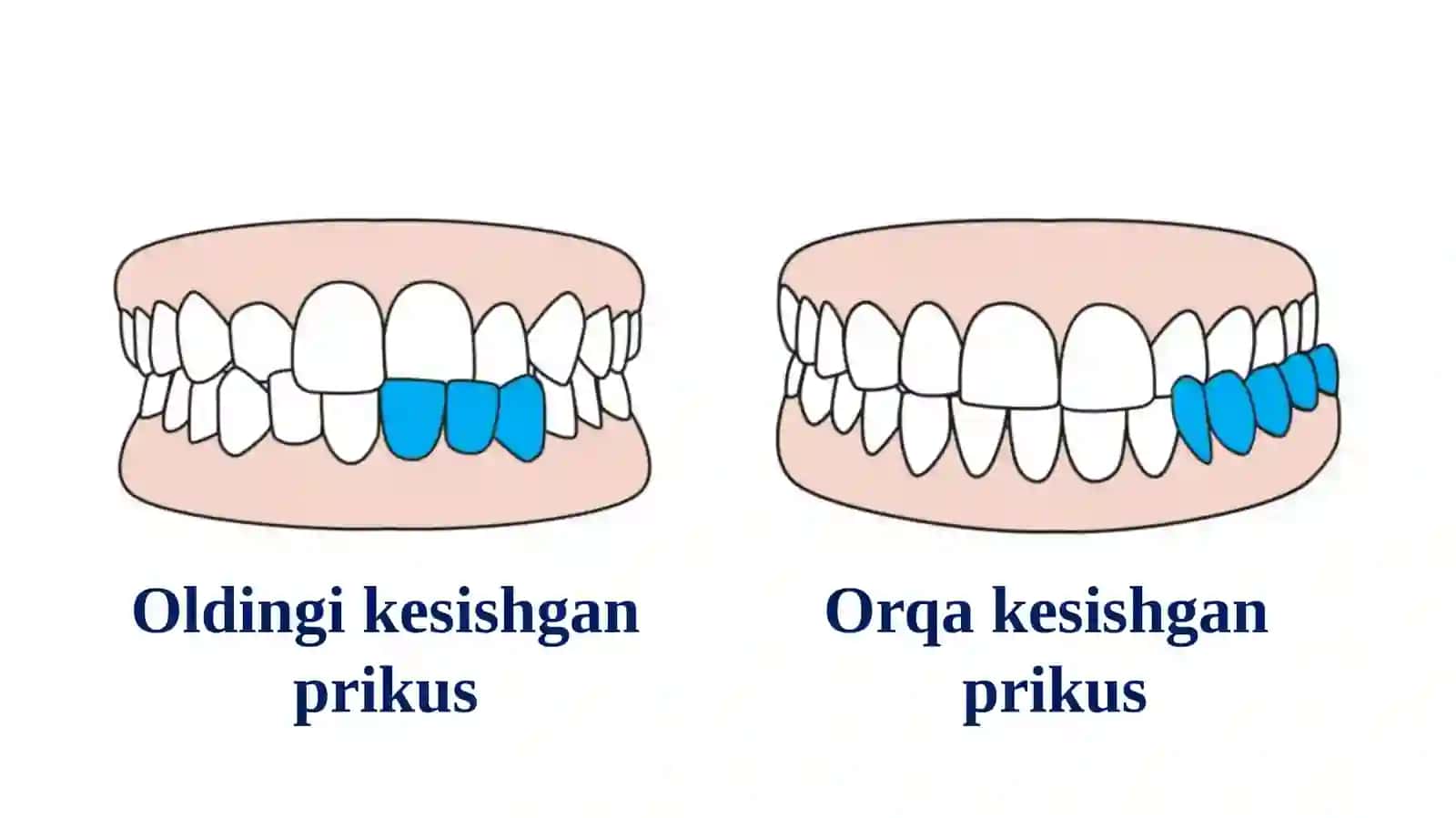 KESISHGAN PRIKUS 4