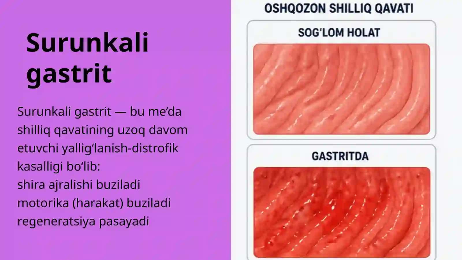 Surunkali gastrit 4