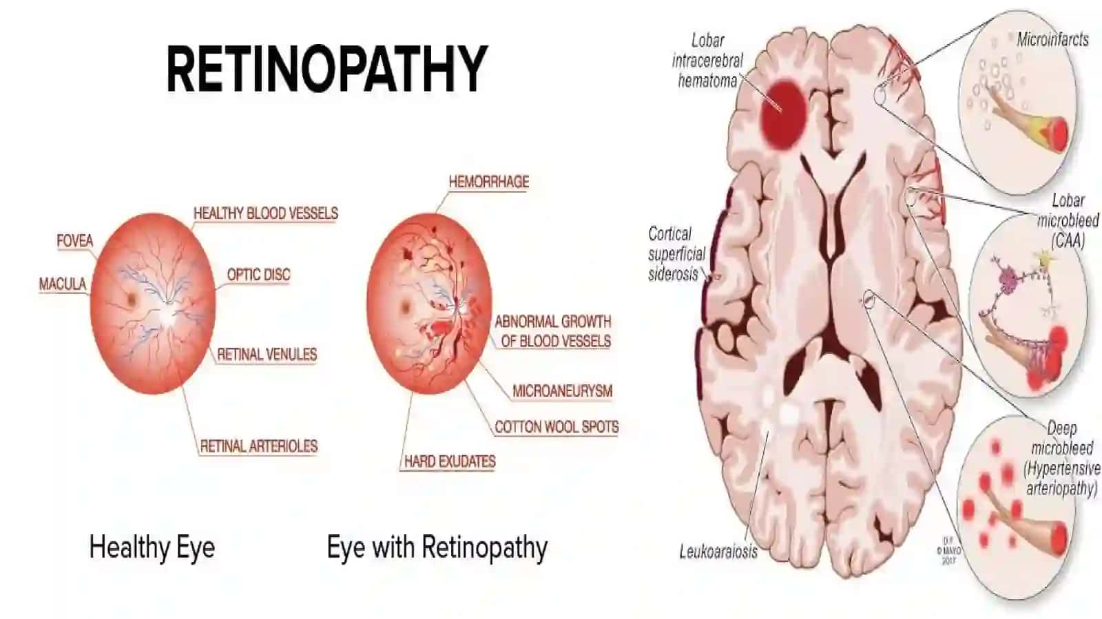 Gipertenziv retinopatiya: etiologiyasi, patogenezi, turlari va klinik belgilari 4