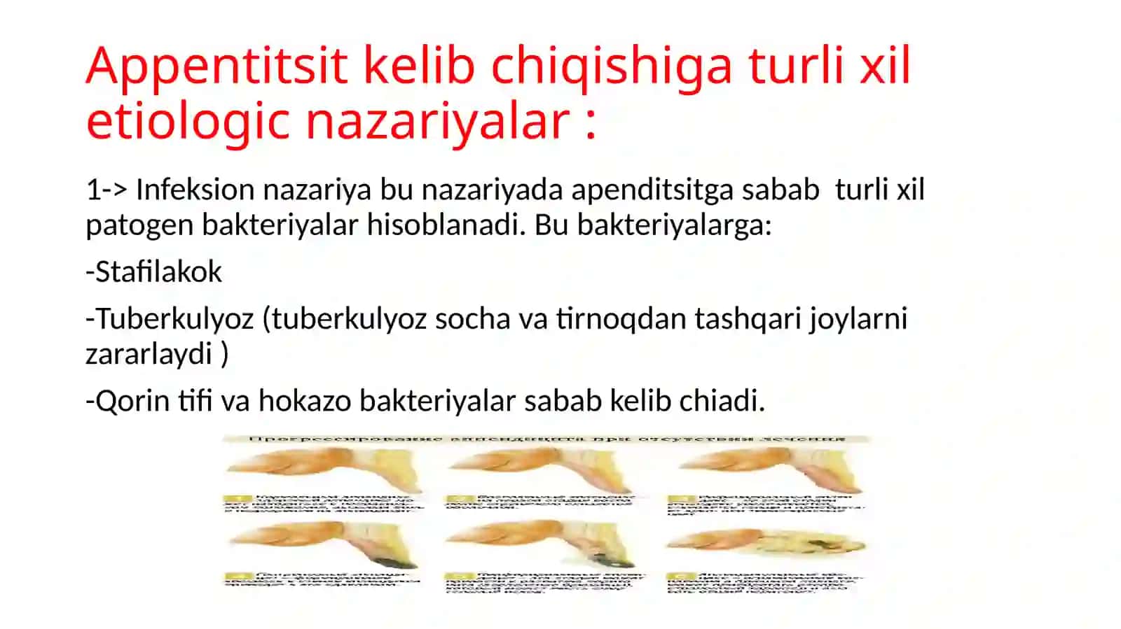 O’tkir appenditsit 4