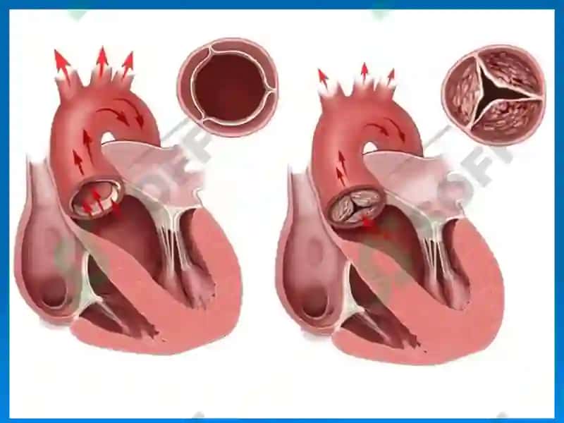 Mitral stenoz 5