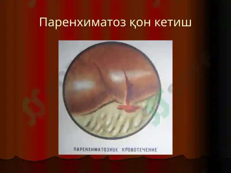 Қон кетиш 5