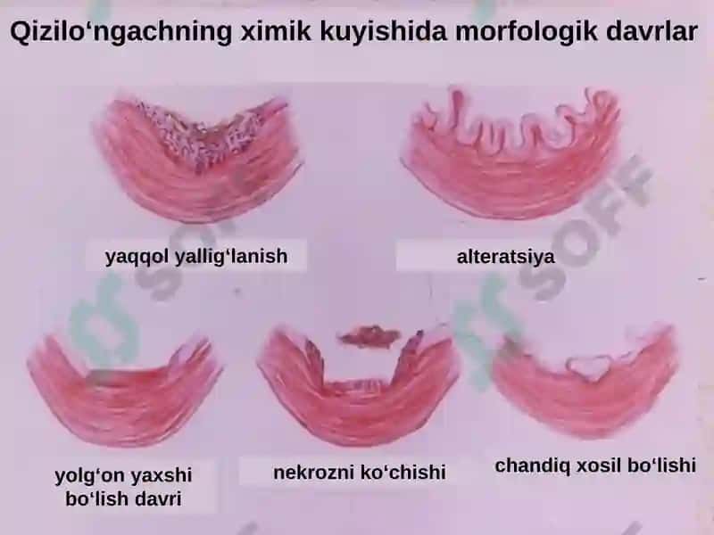 Qizilo‘ngachni ximik va termik kuyishlari 5