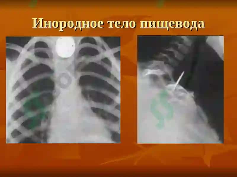 Лучевая диагностика заболеваний желудочно-кишечного тракта 5