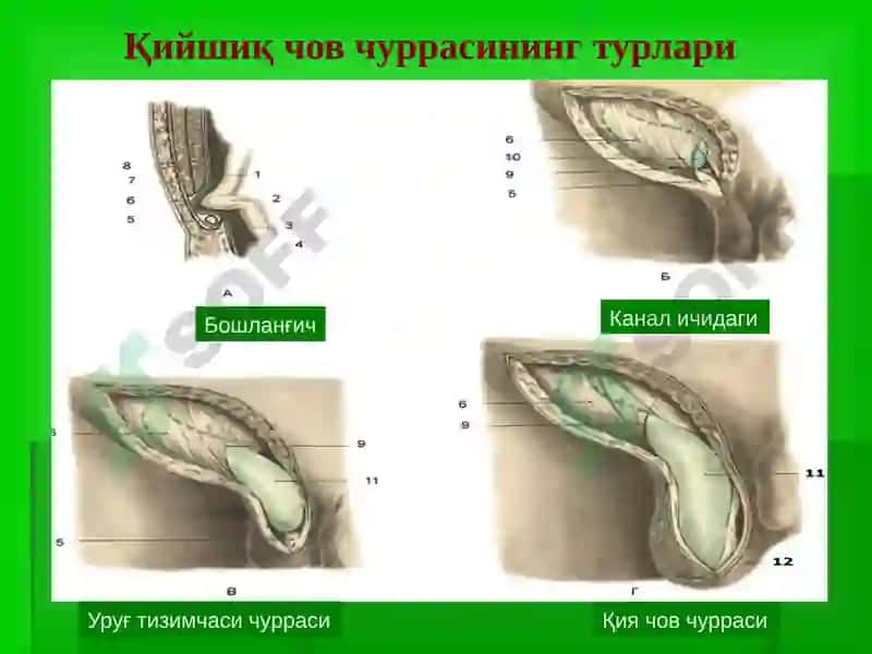 Чов, сон, киндик ва қорин оқ чизиғи чурралари 6