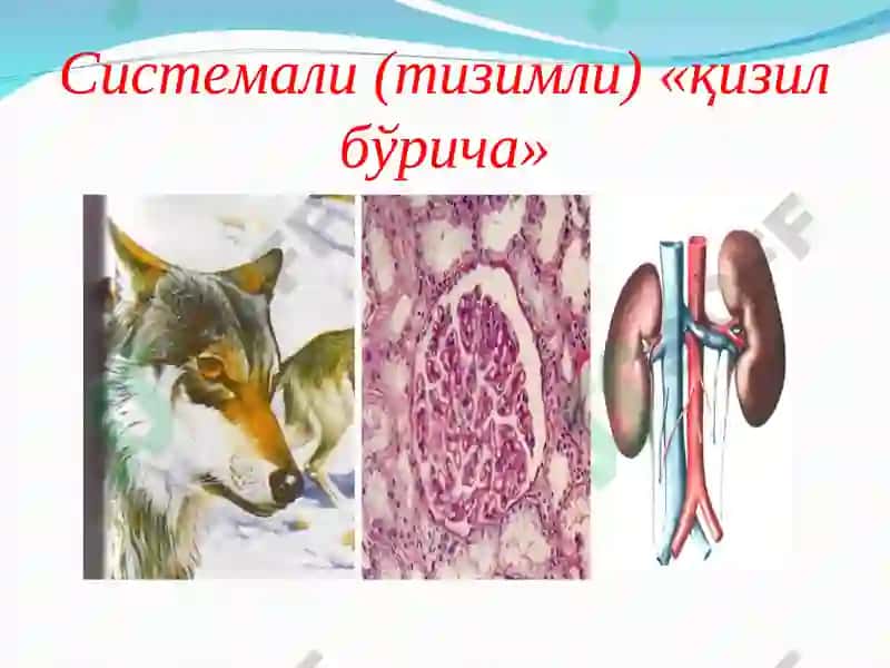 Бириктирувчи тўқима диффуз касалликларида ва ревматоидли артритда буйраклар зарарланиши 6