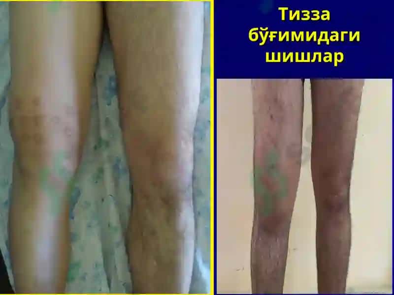 Буғим синдромини таққослама ташхиси ва умумий амалиёт шифокори тактикаси 6