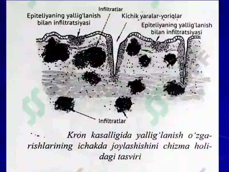 Kron kasalligi 6