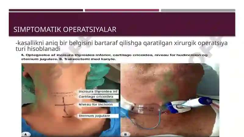 Xirurgik operatsiya qoidalari 6