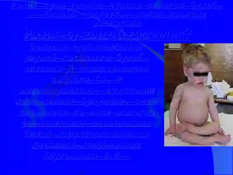 Рахит касаллиги 6