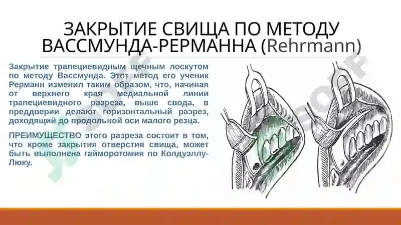 СПОСОБЫ ХИРУРГИЧЕСКОГО ЗАКРЫТИЯ СООБЩЕНИЯ МЕЖДУ ГАЙМОРОВОЙ ПАЗУХОЙ И АЛЬВЕОЛОЙ 6