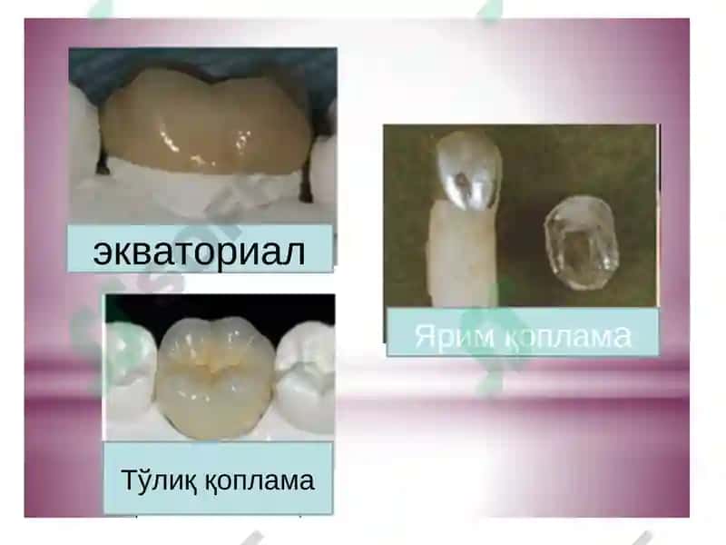 Тиш қаттиқ тўқимасини Суний қопламалар билан ортопедик даволаш.Тўлиқ қуйма қоплама. 6
