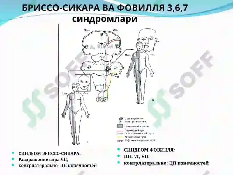 Бош мия ўsmалари 7