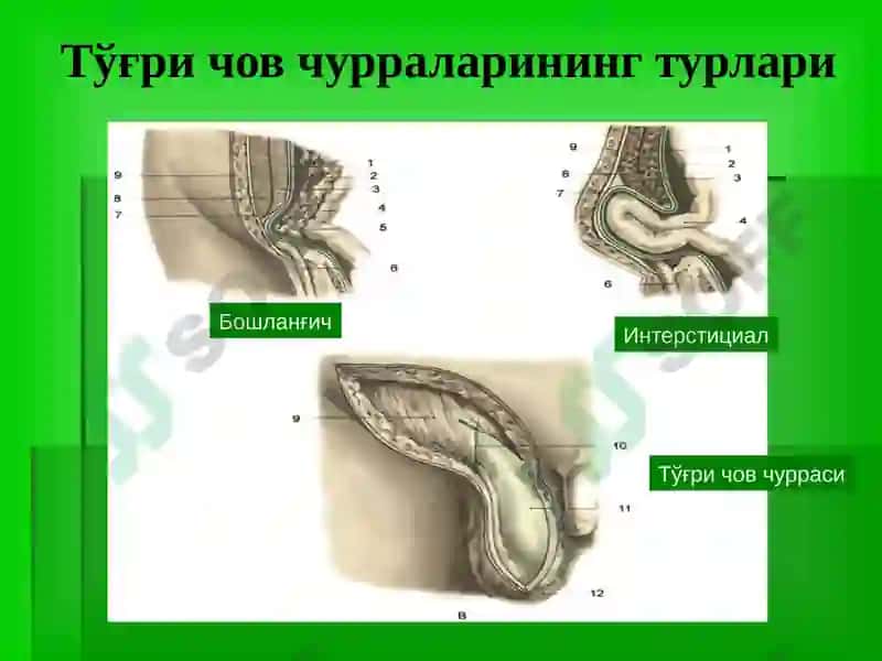 Чов, сон, киндик ва қорин оқ чизиғи чурралари 7
