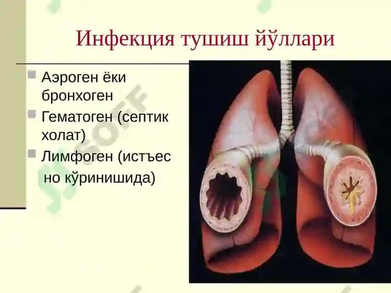 ЎТКИР ПНЕВМОНИЯ 7