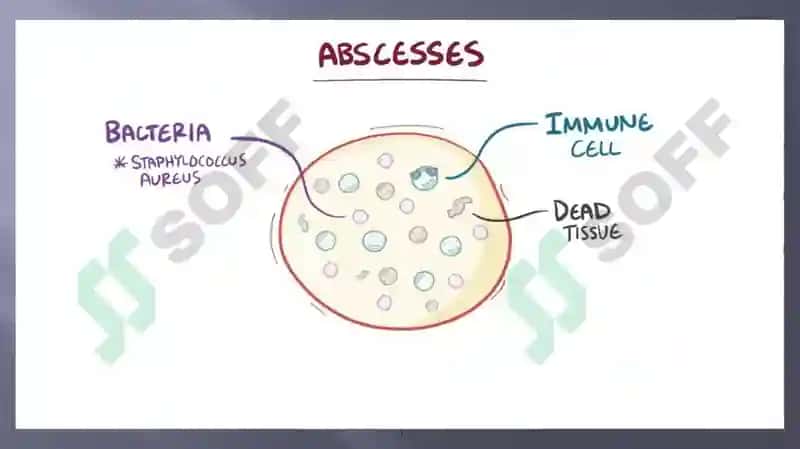 O’PKA ABSESSI VA GANGRENASI ETIOLOGIYASI 7