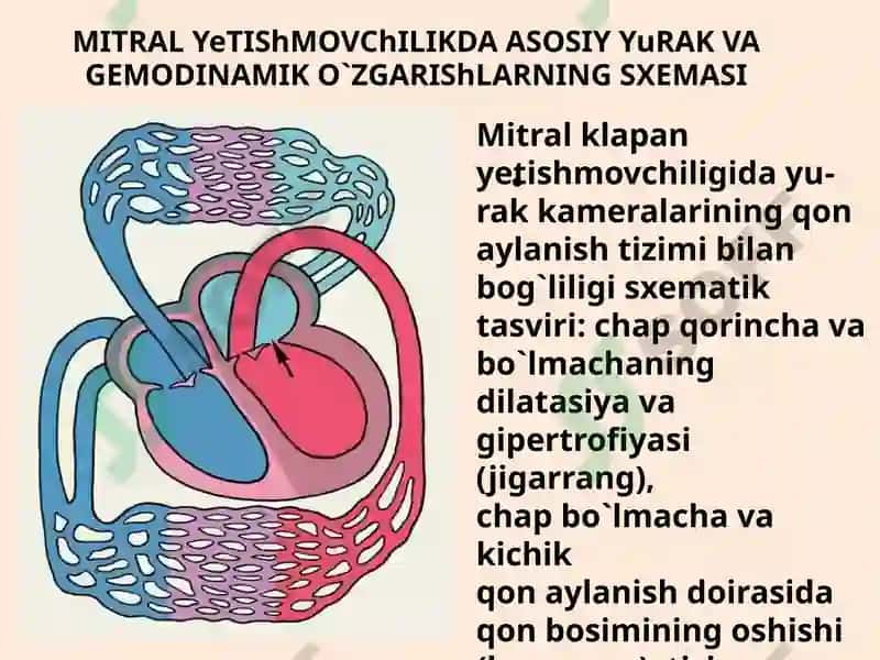 Mitral klapan yetishmovchiligi 7