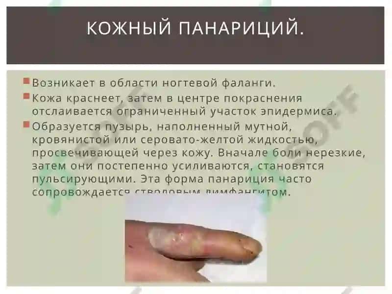 Мастит Панарицый 7