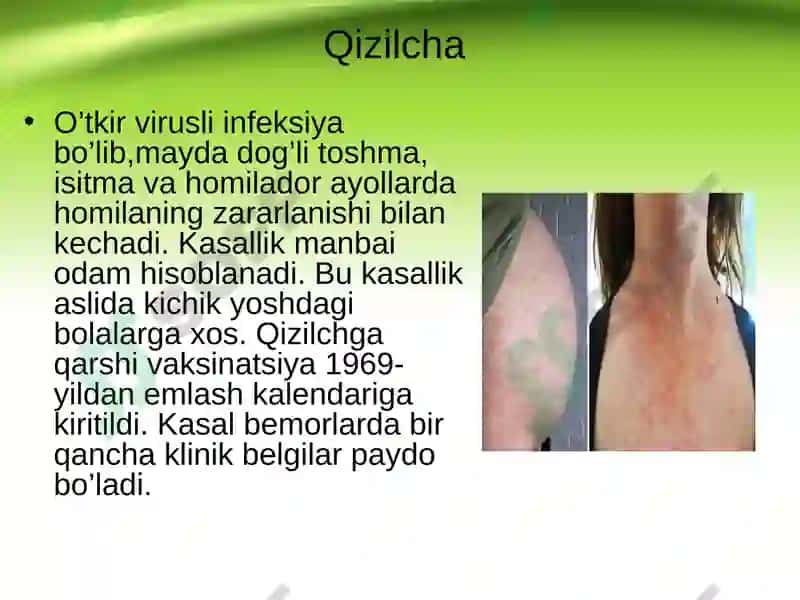 TORCH infeksiyasi 7