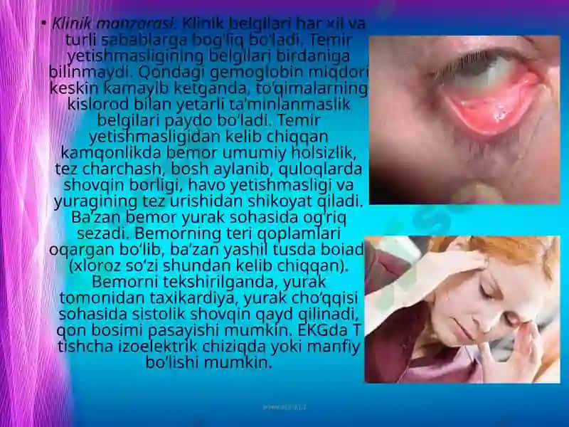 ANEMIYA SINDROMLARI 8
