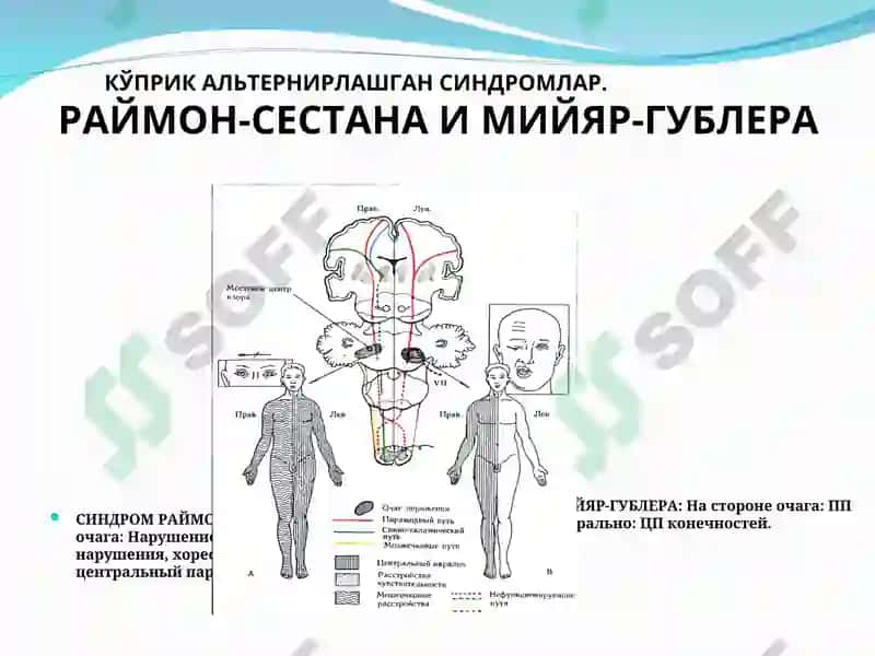 Бош мия ўsmалари 8