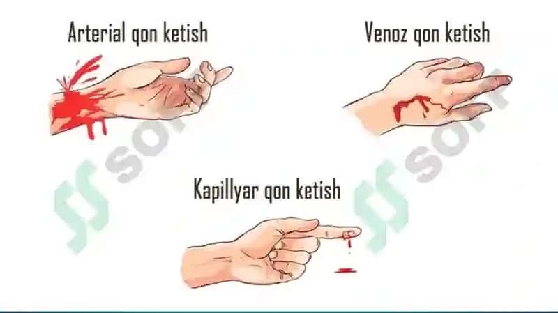 SHIKASTLANGAN O’CHOG’LARDA DASTALABKI SHIFOKOR YORDAMINI TASHKIL ETISH 8