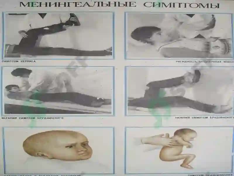 Воспалительныезаболеванияголовного и спинного мозга и их оболочек 8