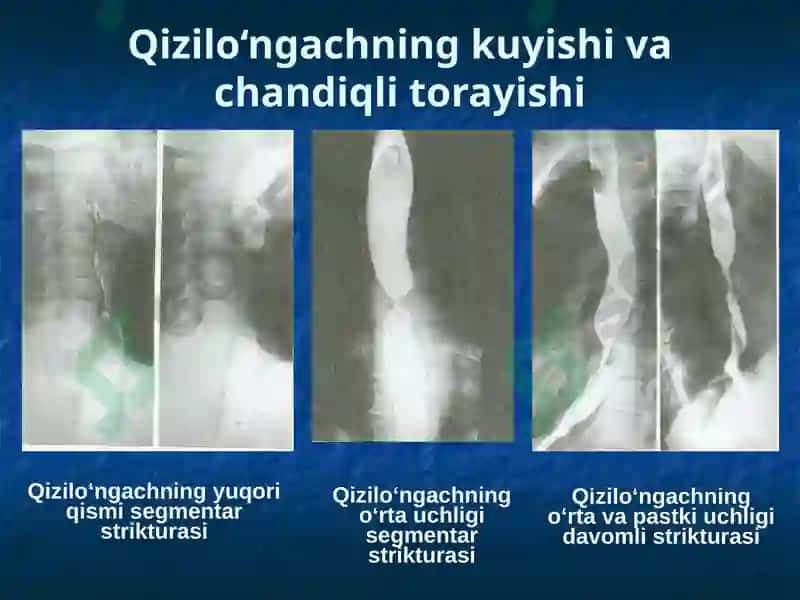 Qizilo‘ngachni ximik va termik kuyishlari 8