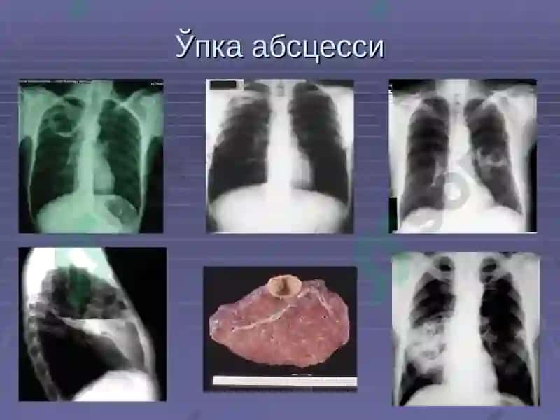 Ўпка сурункали носпецифик йирингли касалликлари 8