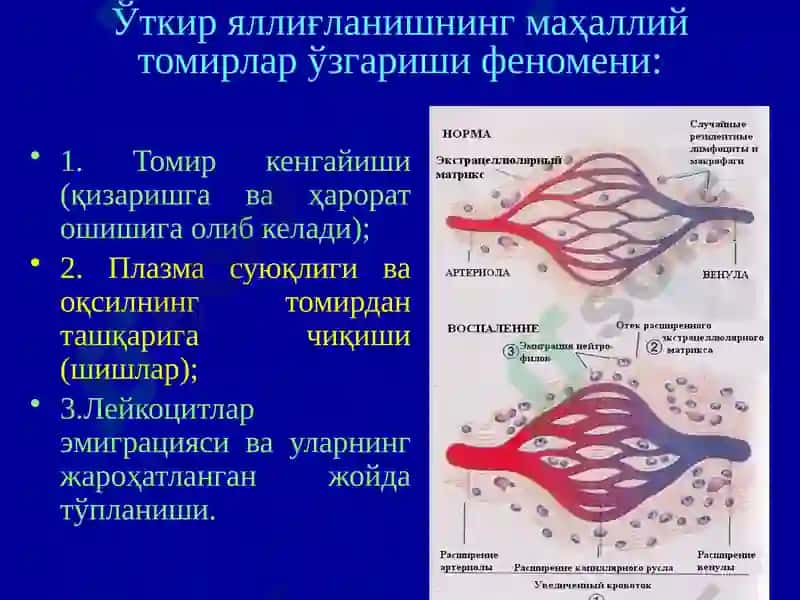 Яллиғланиш. Ўткир ва сурункали яллиғланиш. Яллиғланиш медиаторлари. Яллиғланишнинг морфологик белгилари ва оқибатлари 8