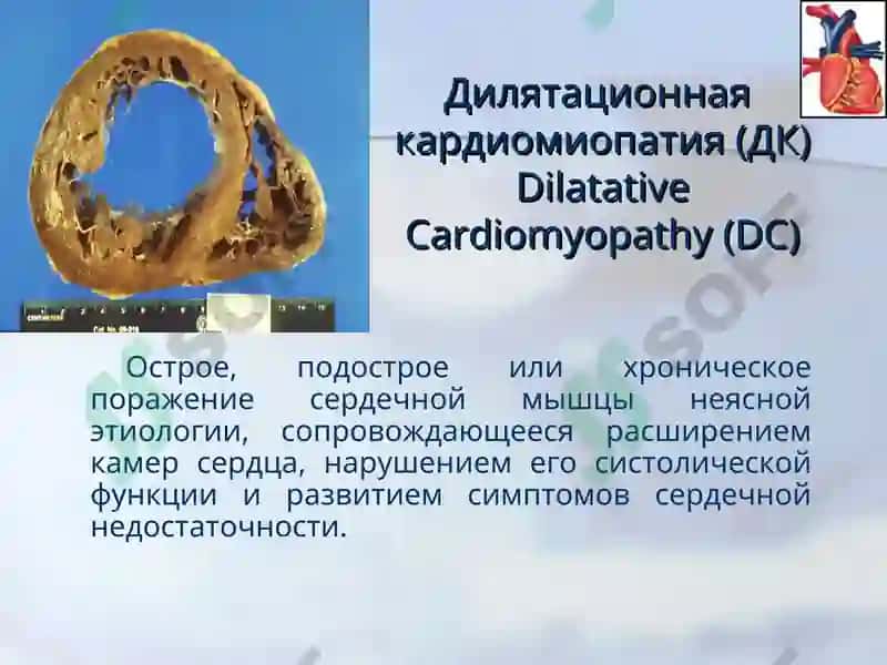 Кардиомиопатии 8