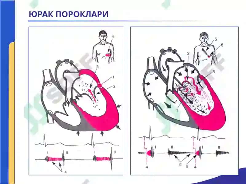 ЮРАК ПОРОКЛАРИ. АОРТА КЛАПАНИНИНГ ЕТИШМОВЧИЛИГИ. 
АОРТА ОҒЗИНИНГ СТЕНОЗИ. 
ҚОН АЙЛАНИШИ ЕТИШМОВЧИЛ 8