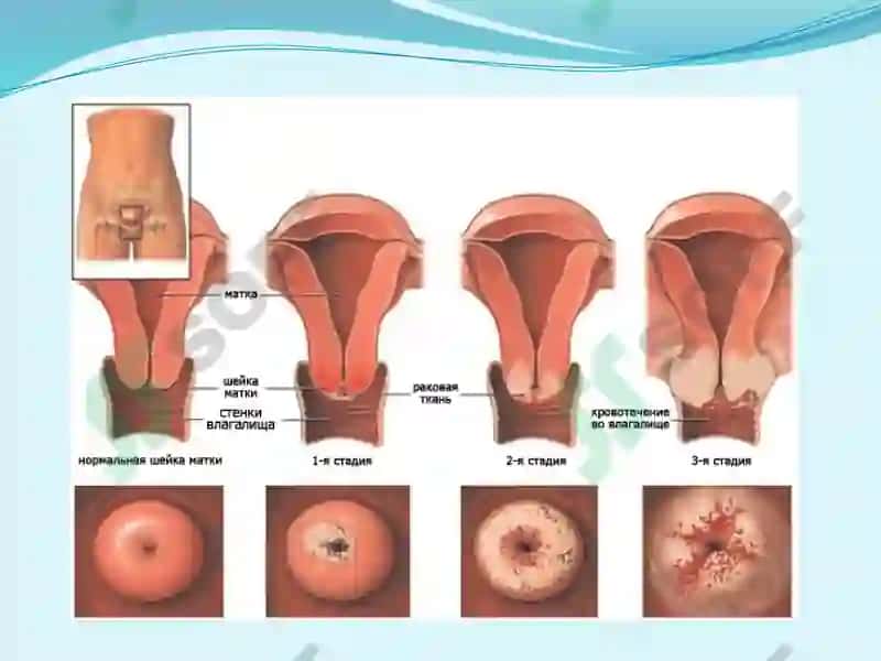 Bachadon bo`yni saratoni nur diagnostikasi va terapiyasi 8