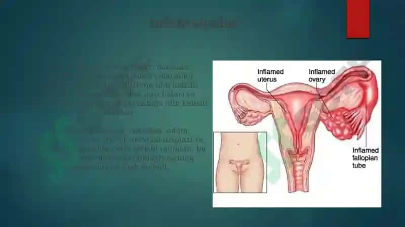 Ayollar jinsiy tizim a'zolari yallig'lanish jarayonini patofiziologiyasi 8