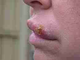 Герпес (Herpes simplex)