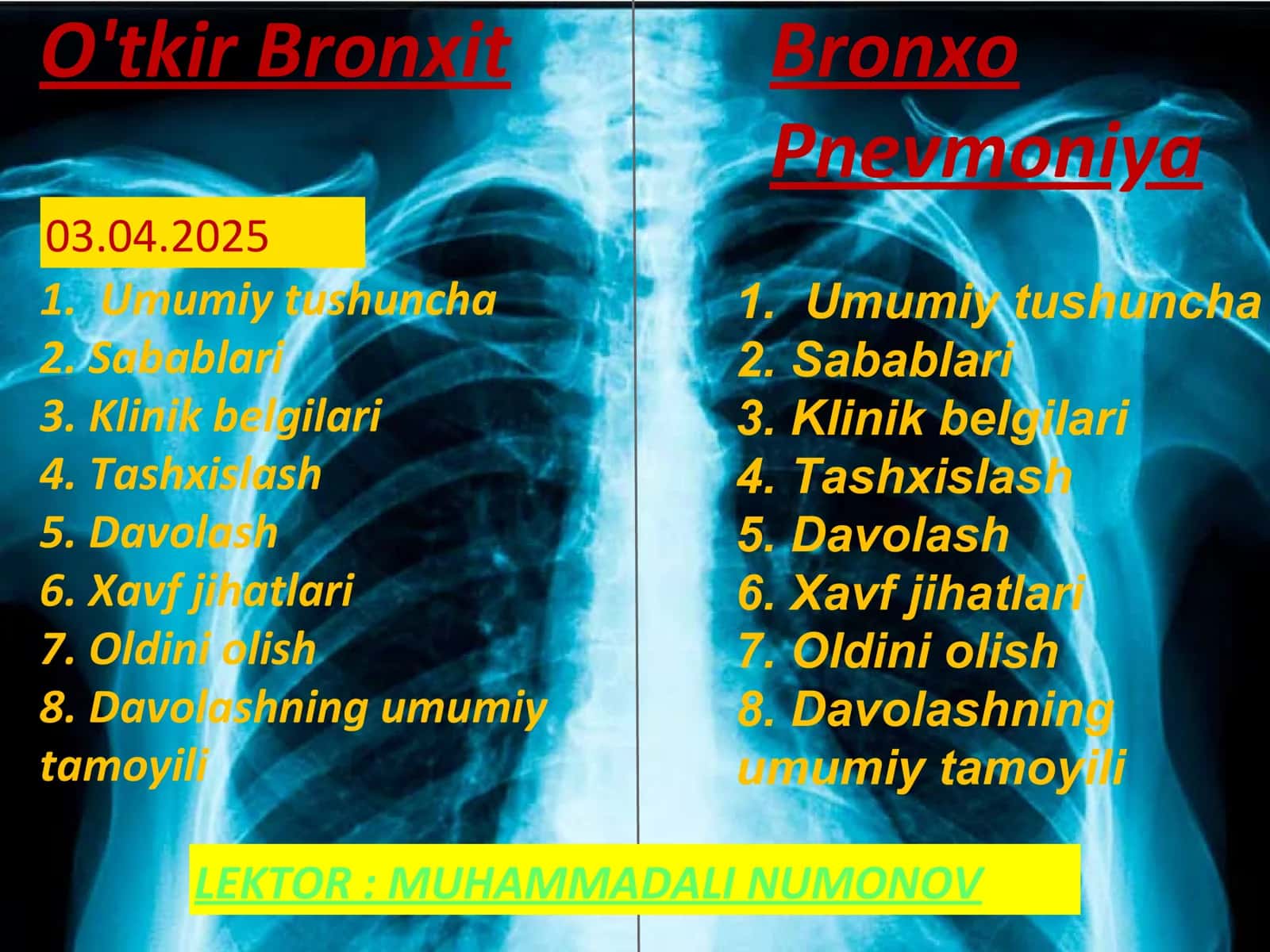 O'tkir Bronxit