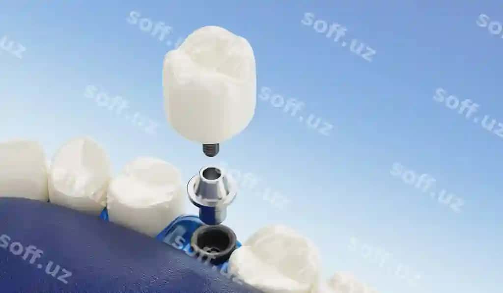 Yaqin qarash komponent dental implantatsiyalari shaffof 3D render | Close up component dental implants transparent 3d rendering 2