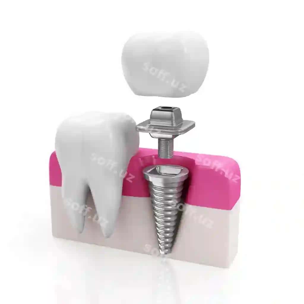 Sog'liq tish implanti | Health tooth dental implant 2