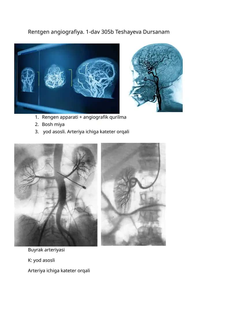 Rentgen angiografiya
