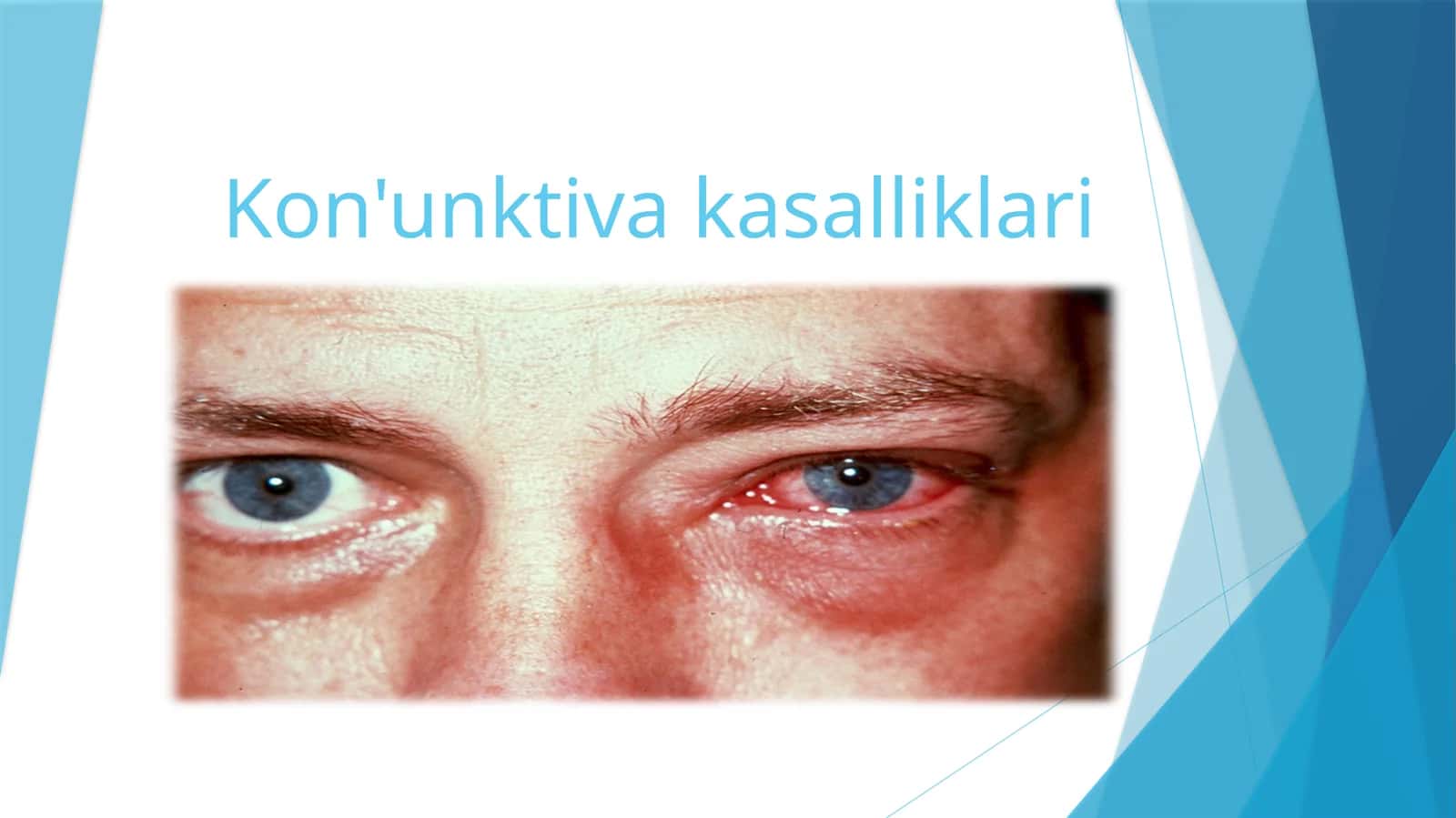Kon'unktiva kasalliklari