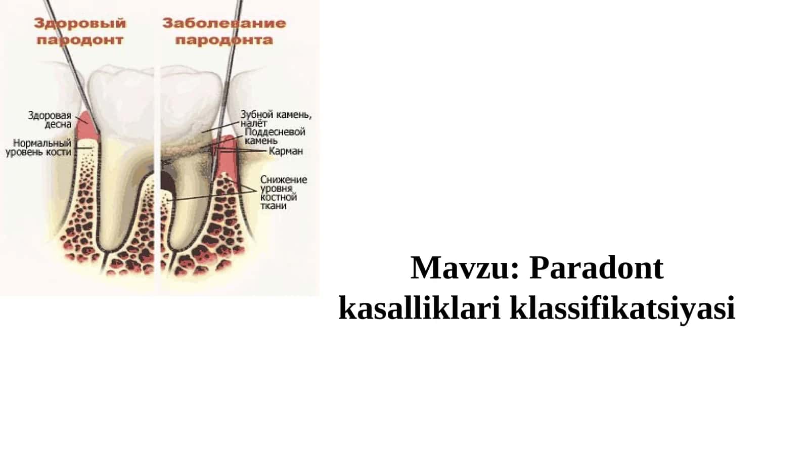 Paradont kasalliklari klassifikatsiyasi