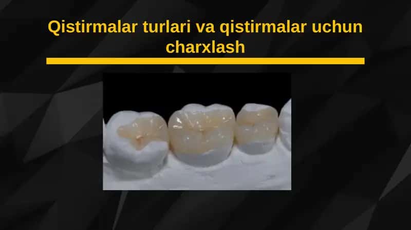 Qistirmalar turlari va qistirmalar uchun charxlash