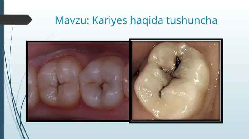 Kariyes haqida tushuncha
