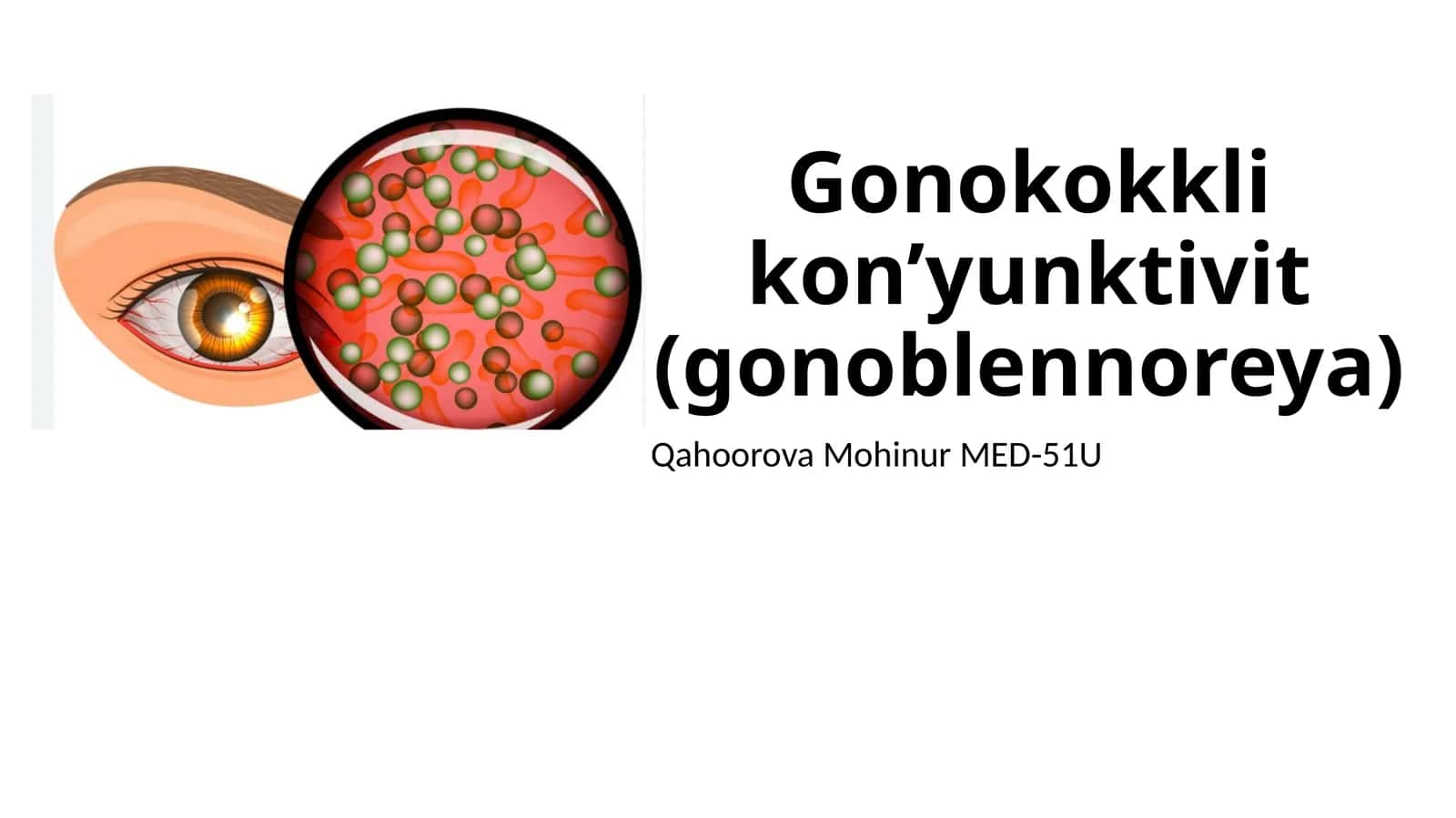 Gonokokkli kon’yunktivit(gonoblennoreya)