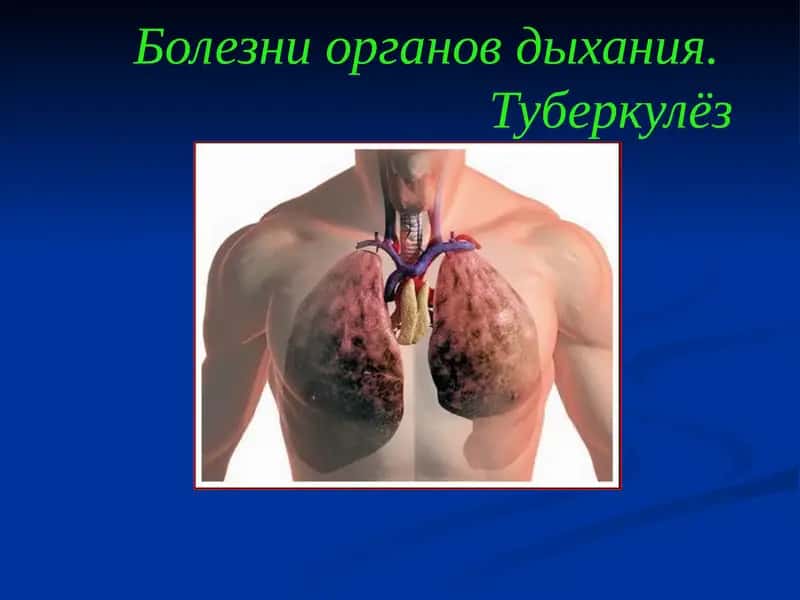 Острый бронхит (bronchitis acuta)