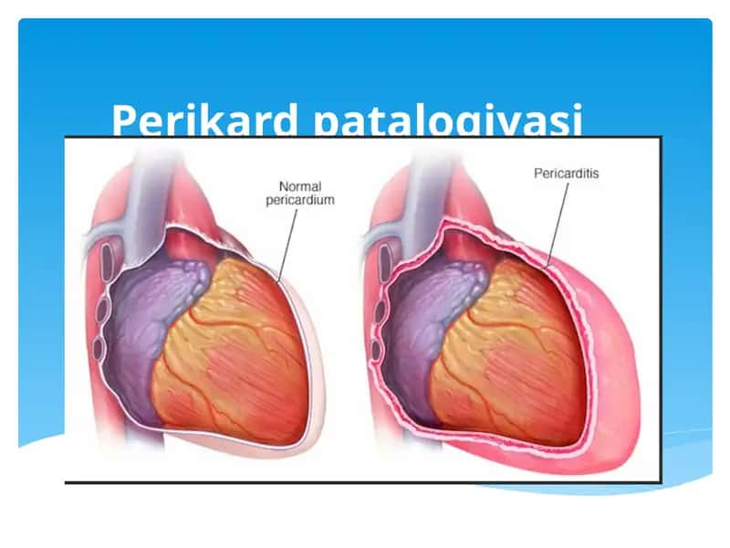 Perikardpatalogiyasi