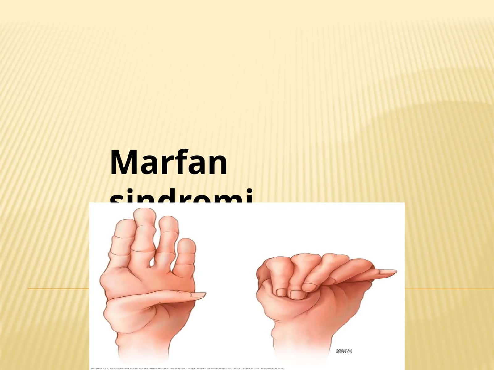 Marfan sindromi